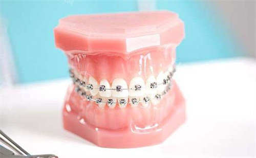 钢丝牙套一般要戴多久？通常需要1-3年左右，但佩戴时长因人而异！(图5)