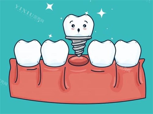 韩国奥齿泰种植体SS系统型号介绍：主要包含标准版（R4.8）和宽体版（W6.0）两种型号(图1)