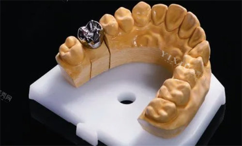 韩国奥齿泰种植体SS系统型号介绍：主要包含标准版（R4.8）和宽体版（W6.0）两种型号(图3)