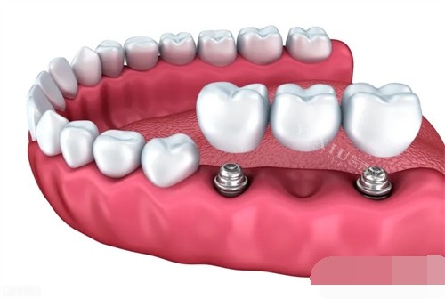 韩国奥齿泰种植体SS系统型号介绍：主要包含标准版（R4.8）和宽体版（W6.0）两种型号(图4)