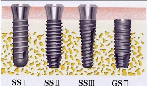 韩国奥齿泰种植体SS系统怎么样？在稳定性、美观性和经济性方面表现均衡(图1)