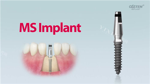 韩国奥齿泰种植体SS系统怎么样？在稳定性、美观性和经济性方面表现均衡(图3)