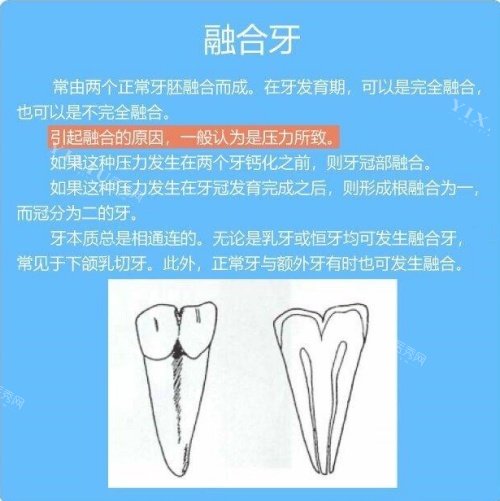 融合牙介绍示意图