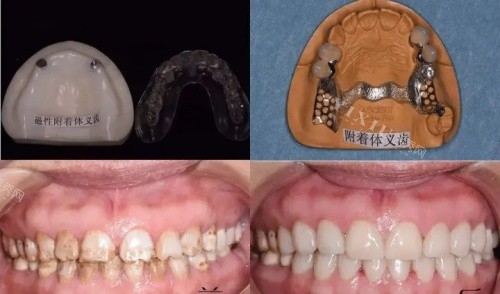 附着体一义齿全口展示