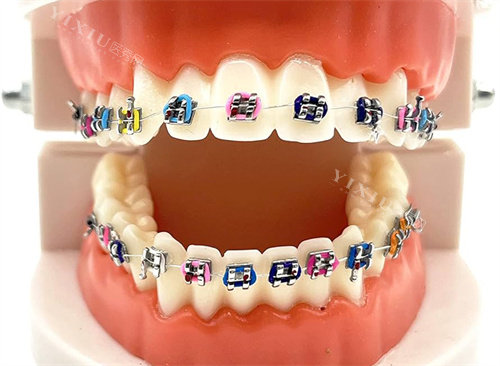 金属托槽矫正模型图片