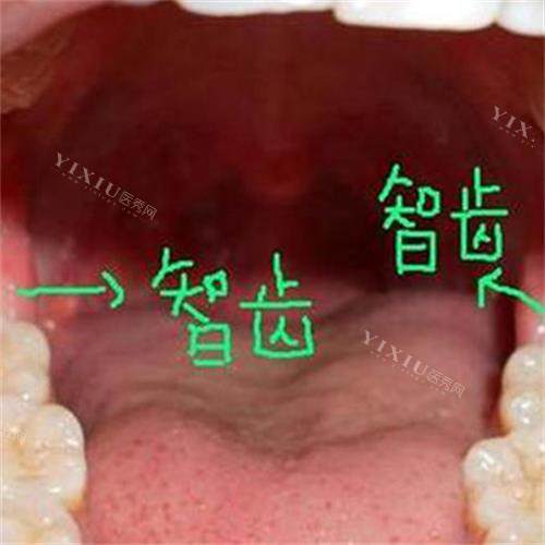牙齿智齿所在位置