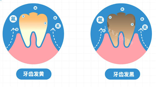 氟斑牙
