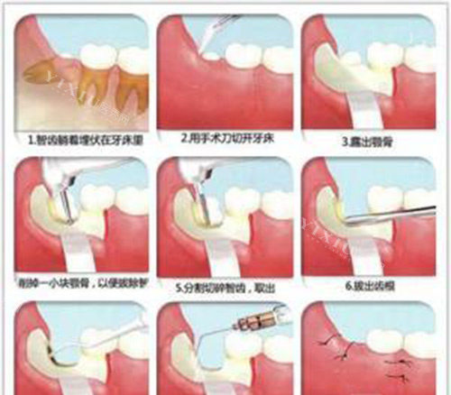 拔智齿过程示意图