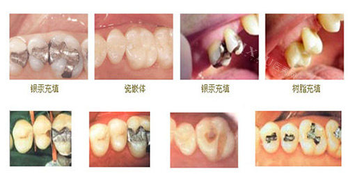 不同牙齿修补示意图
