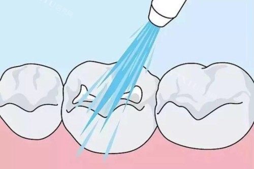 儿牙涂氟卡通图