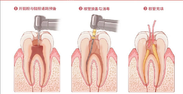 根管治疗展示