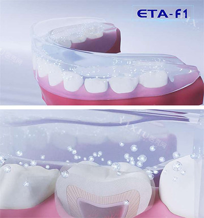 ETA牙齿矫正器