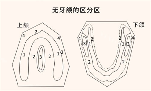 无牙颌分区图