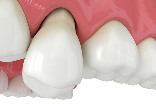 牙齿松动模型图