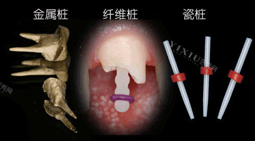 牙齿打桩材质