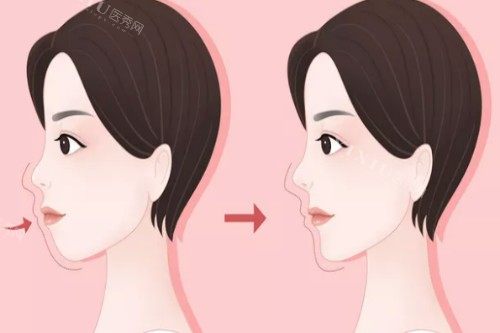 凸嘴改善前后对比图