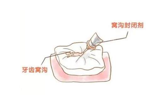 窝沟封闭示意图