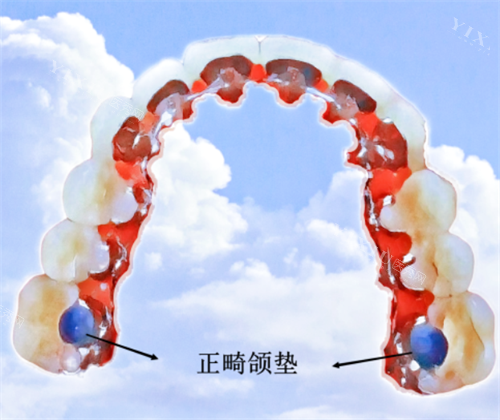 正畸颌垫示意图