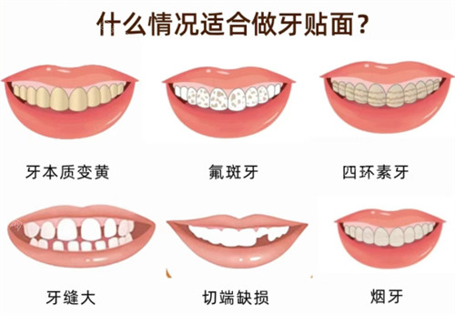 适合做牙贴面的情况