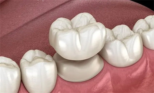 牙冠是怎么做的 牙冠是怎么做的