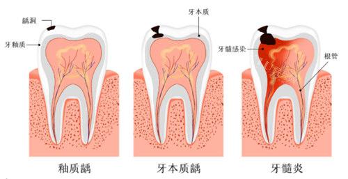 牙髓炎发展过程