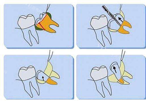 不同智齿类型实验题