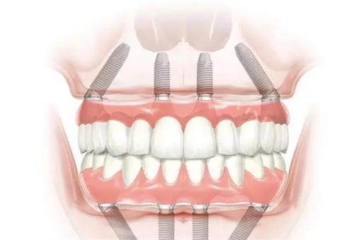 应城牙齿治疗收费标准分享，2025年做种植牙2980+牙齿矫正6000+补牙98+点击了解！(图2)