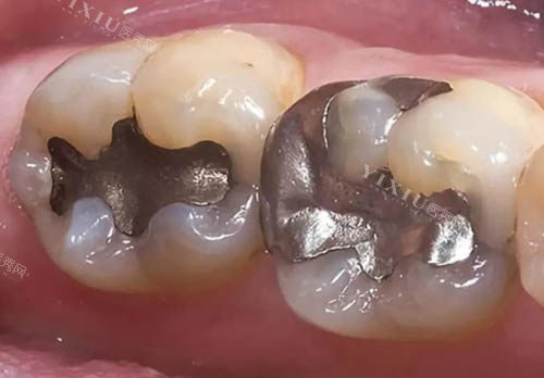 应城牙齿治疗收费标准分享，2025年做种植牙2980+牙齿矫正6000+补牙98+点击了解！(图5)