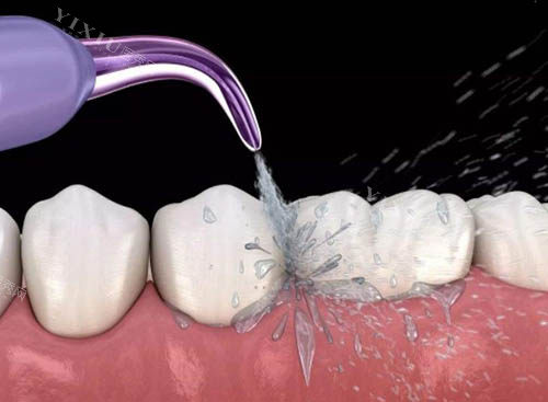 应城牙齿治疗收费标准分享，2025年做种植牙2980+牙齿矫正6000+补牙98+点击了解！(图6)