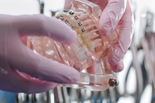 牙齿模型参考图