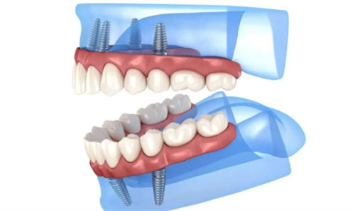 全口种植模拟图