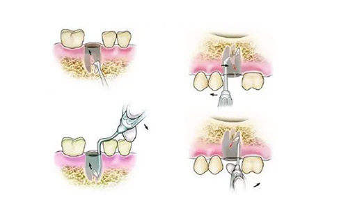 抽牙神经价格表：前牙800元vs后牙1500元+冠修复成本指南！(图1)