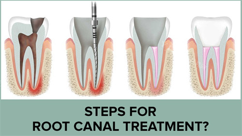 抽牙神经价格表：前牙800元vs后牙1500元+冠修复成本指南！(图3)