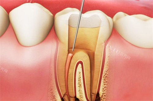 抽牙神经价格表：前牙800元vs后牙1500元+冠修复成本指南！(图5)