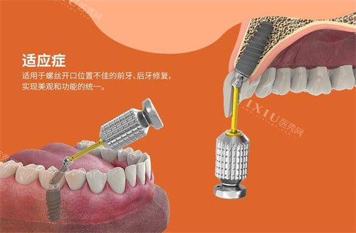 百齿泰植体适应症展示图
