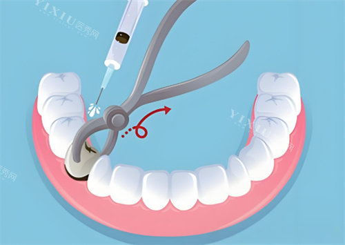 <span class='highlight'><span class='highlight'>***</span></span>拔牙