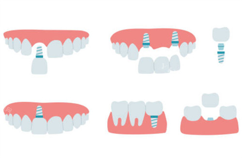 西安莎莎口腔周末急诊服务！拔智齿220元起，夜间营业至晚8点！(图1)