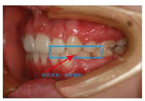 牙齿正常咬合图.webp