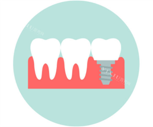 阿波罗 Apollo种植牙使用寿命有多久？使用寿命通常在10-30年之间(图1)