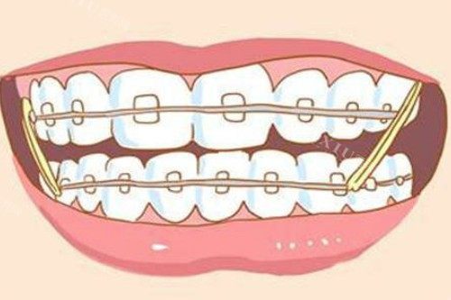 肥西爱牙口腔价格大揭秘！补牙 68 元起，正畸 6200 元起，太划算了！(图1)