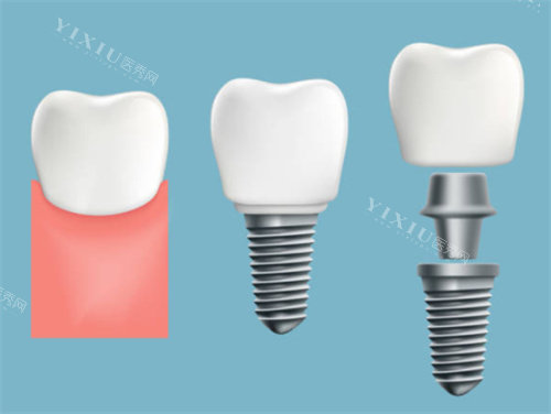 肥西爱牙口腔价格大揭秘！补牙 68 元起，正畸 6200 元起，太划算了！(图4)