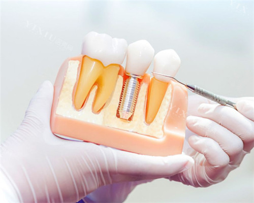 石家庄三博口腔多少钱？种植牙3500元起、牙齿矫正5000元起、补牙150元起、牙冠800元起！(图2)