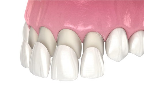 石家庄三博口腔多少钱？种植牙3500元起、牙齿矫正5000元起、补牙150元起、牙冠800元起！(图6)