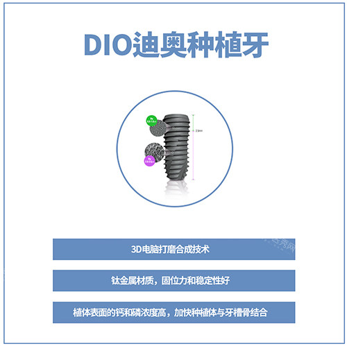韩国DIO种植牙讲解图