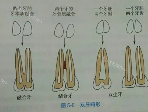 融合牙结合牙双生牙示意图