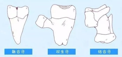 融合牙结合牙双生牙漫画图