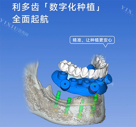 利多齿种植牙怎么样