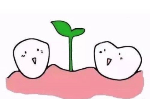 种植牙概念图