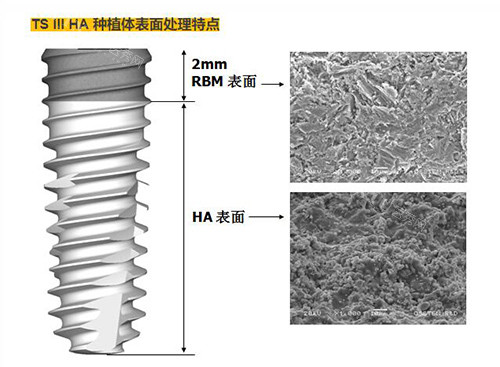 奥齿泰TS3植体材质优势