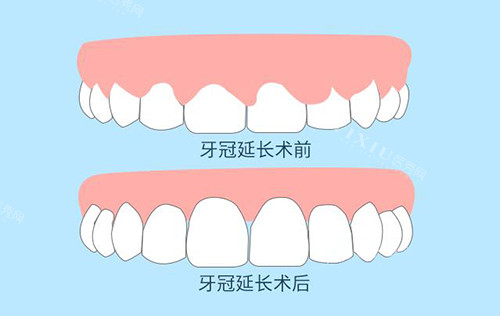 牙冠延长前后对比照片
